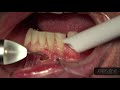 how to use the gemini laser lower anterior frenectomy