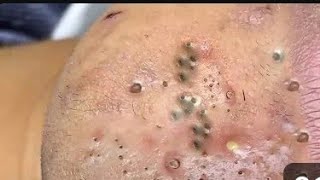 Relaxing Popping Video😨😰😱 Pimple popping black head remove Satisfaction With Popping