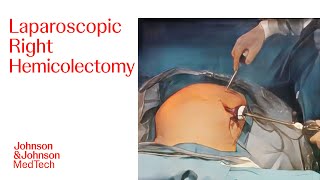 Laparoscopic Right Hemicolectomy HARMONIC ACE®+ Shears | J\u0026J MedTech