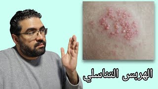 عيادة الجلدية - حلقة ٦ - الهربس التناسلي