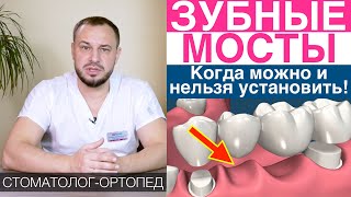 Зубные мосты - что это, когда можно и нельзя устанавливать мостовидные зубные протезы.