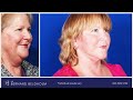 rhytidectomy facelift with liposuction of neck patient 3044 before u0026 after