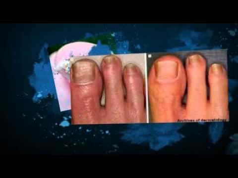 How do you use Vicks VaporRub for nail fungus?