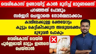 വെരിക്കോസ് ഉണ്ടായിട്ട് കാൽ മുറിച്ചു മാറ്റണമെന്ന് പറഞ്ഞത് പോലും സർജറി ചെയ്യാതെ നോർമലാക്കാം |