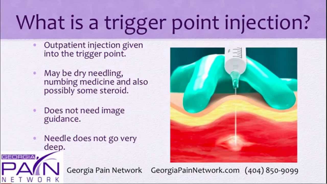 Trigger Point Injections Trigger Point Injection Tech Vrogue Co Trigger Point Injections Trigger Point Injection Tech Vrogue Co