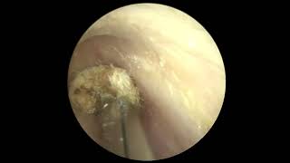 귀의 면봉제거 (removal of foreign body in the ear canal)