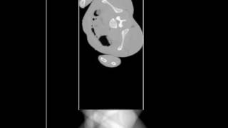 Radon Transform: Pelvis