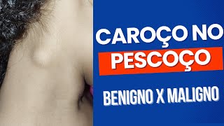 Caroço no pescoço - linfonodo benigno ou maligno?