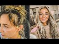 I started losing my hair in my 20s, here's how I grew it back