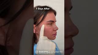 Fox Eyes Surgery | Before And 7 Days After