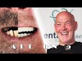 All On 5 (Full Mouth Implant Restoration) / Testimonial