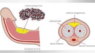 Choroba Peyroniego