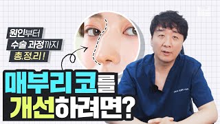 매부리코를 교정하는 가장 확실한 방법