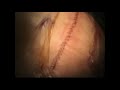 bbc 2 documentary clip about stuart s hip resurfacing