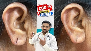 कान का छेद छोटा करने का आसान तरीका / Ear Pasting Lotion / EarLobe Repaire /  Torn Ear / Ear Glue