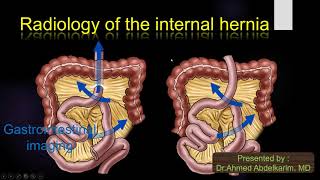 19-Radiology of the internal hernia