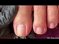 vlog 604 dry skin ingrown removal pedicure 504