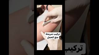 طريقة تركيب شريحة منع الحمل