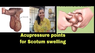 Acupressure points for Scrotal swelling / Hydrocele( paid phone consultation WhatsApp on 9940644411)