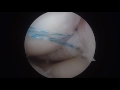 meniscus root tears unique injuries requiring anatomic repair james dreese md