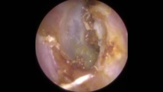 Lifting ear wax and dead skin off Eardrum - Mr Neel Raithatha (The Hear Clinic)