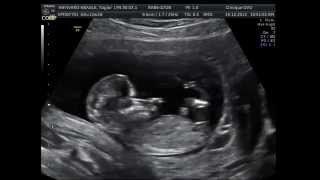 12w6d Ultrasound