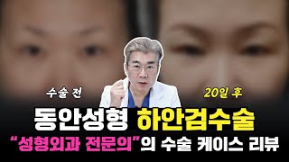 성형외과 전문의가 직접 집도한 하안검 수술 리뷰😎│50대 중년 여성분의 변화까지 대공개😀