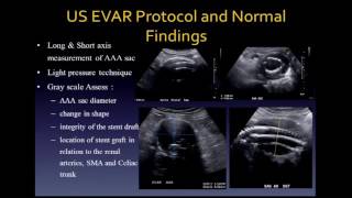 Complications of Endovascular Stent Graft Repair