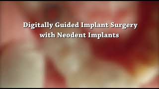 Digitally Guided Implant Surgery with Neodent GM Helix Implant