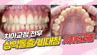 상악돌출/비대칭 치아교정_그랑교정치과