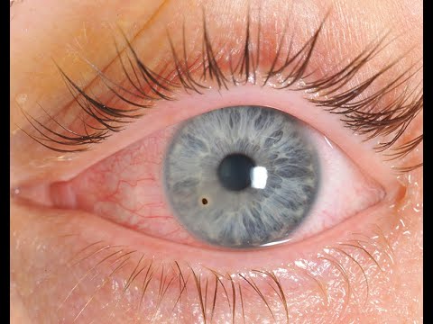 Corneal Foreign Body Removal 1 - YouTube