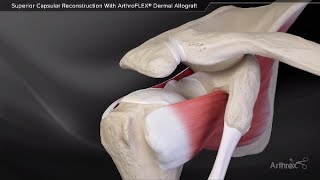 Superior Capsular Reconstruction With ArthroFLEX® Dermal Allograft