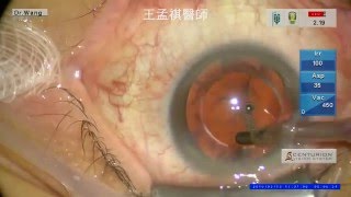 高度近視早發性白內障之飛秒雷射白內障手術 high myopic presenile cataract using FLACS