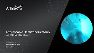 Arthroscopic Hemitrapeziectomy and CMC Mini TightRope®