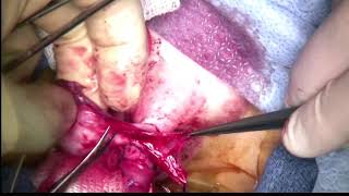 Core Videos (2018): Proximal Hypospadias 1 Stage Repair