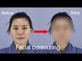 Face Contouring and Rhinoplasty  | Seoul Guide Medical