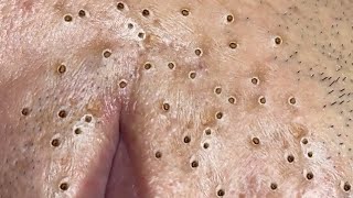 Big Cystic Acne Blackheads Extraction Blackheads \u0026 Milia, Whiteheads Removal Pimple Popping # 8686