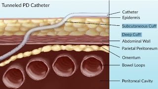 Complications of Peritoneal Dialysis by S. Su | OPENPediatrics