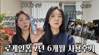 정수리 탈모! 여성용 로게인폼 5% 2년6개월 사용후기 (📸before/after, 대학병원 상담, 사용방법, 쉐딩, 부작용)