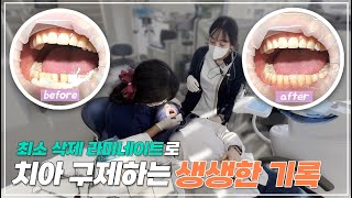 치과의 아침부터 퇴근까지! 최소 삭제로 라미네이트 하는 현장 같이 보시죠