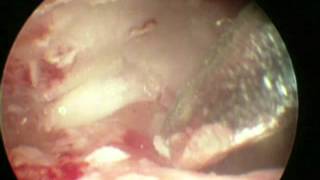 Endoscopic Ear Surgery (Mastoid exploration) .mp4