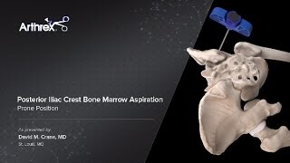 Posterior Iliac Crest Bone Marrow Aspiration - Prone Position