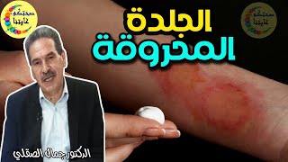 حروق في الجلد..أحسن مكون طبيعي مطهر و ملحم للحروق  -  الدكتور جمال الصقلي  -