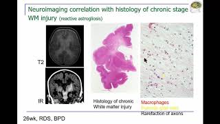 ISMRM MR Academy - Preterm newborns: How imaging contributes to the understanding of the preterm