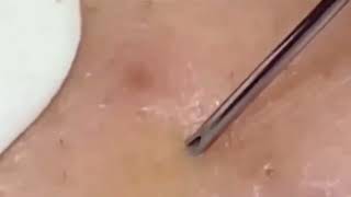 超解壓 44  Huge blackheads and pimples