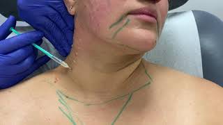 Neck rejuvenation using a modified \