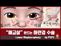 애교살을 만드는 하안검 성형의 기술 by 성형외과 전문의