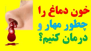 خون دماغ را چطور مهار و درمان کنیم؟