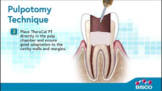 TheraCal PT Whiteboard Video | Discover Our Pulpotomy Treatment