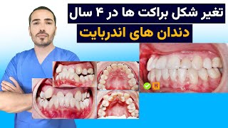 تغیرشکل‌ براکت ها در ۴ سال|ارتودنسی دندان|دندان های اندربایت|کلینیک دندان علومی|